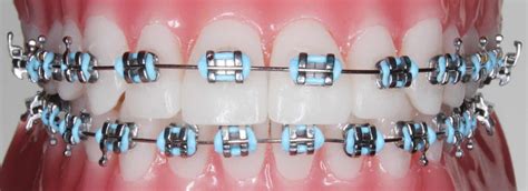 teeth white braces metal brackets|metal brackets at home depot.